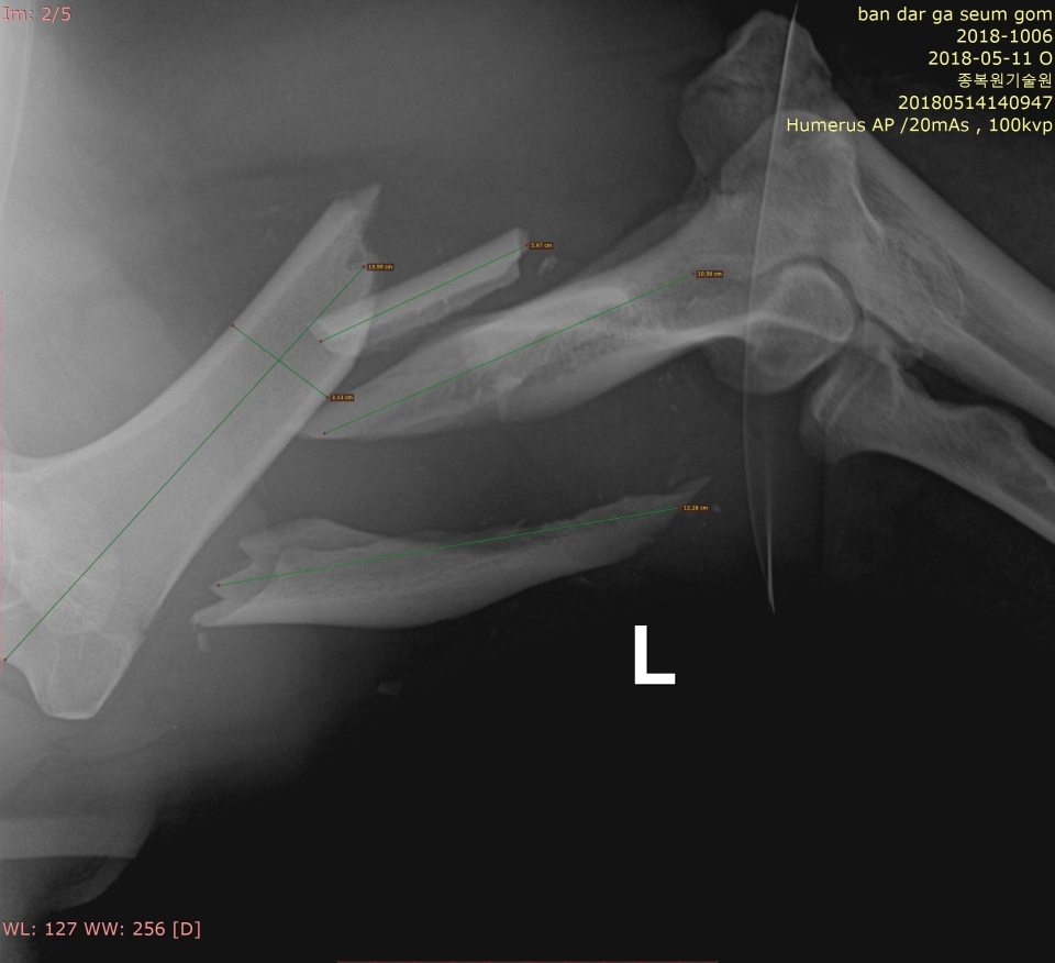 복합골절 부위의 X-RAY 사진. (환경부 제공)