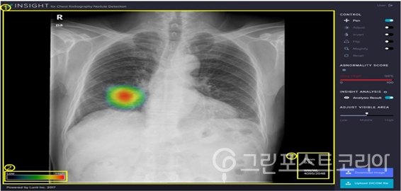 흉부 단순촬영(X-ray) 영상에서 폐결절로 의심되는 이상부위를 검출해 의료인의 진단을 지원하는 소프트웨어 '루닛 인사이트'(식약처 제공)/그린포스트코리아
