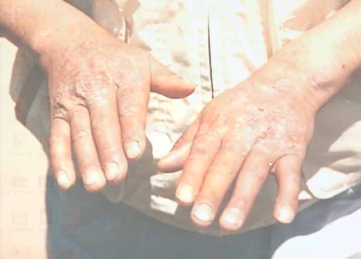 피부병을 앓고 있는 온산병 환자의 손. (유튜브 다큐멘터리 캡처) 2018.11.24/그린포스트코리아