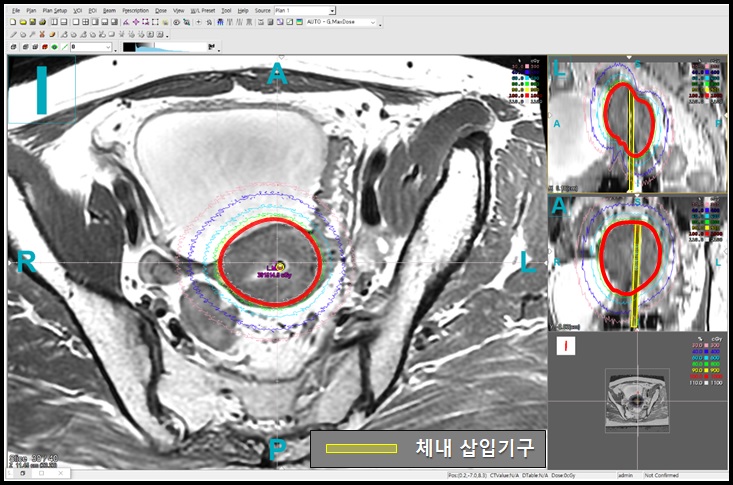 한국연구재단은 임영경 박사(국립암센터) 연구팀이 자궁경부암 치료 시 좌우 비대칭 형태로 성장한 종양 부위에도 방사선을 집중할 수 있는 근접방사선치료 기술을 개발했다고 25일 밝혔다.(사진 한국연구재단 제공) 2019.9.25/그린포스트코리아